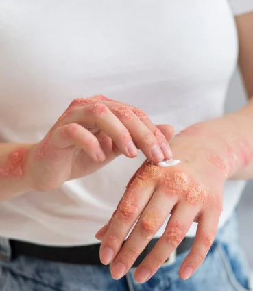 psoriasis-img